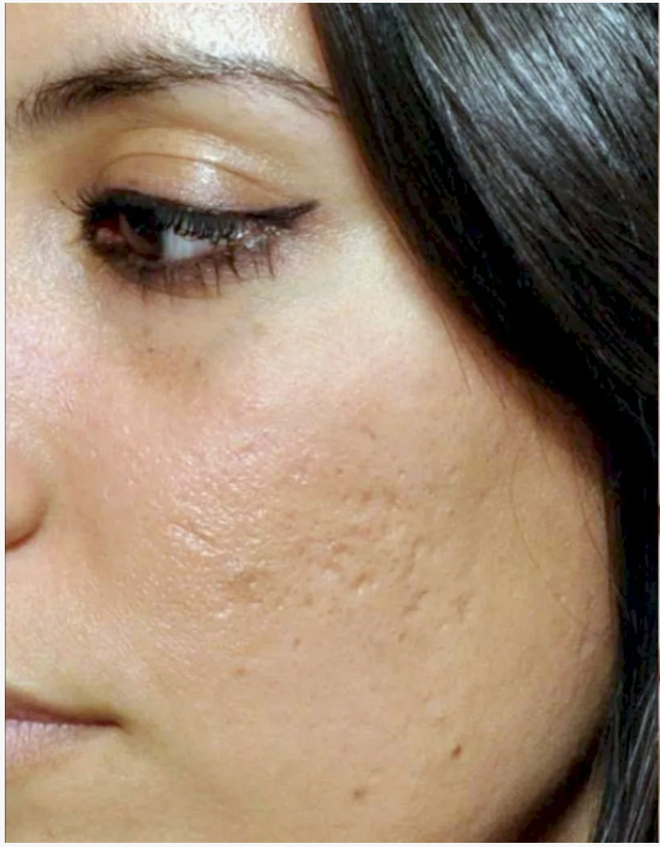 Carbon peel centre dakhla agadir